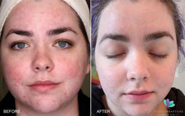 before and after image of a microneedling treatment