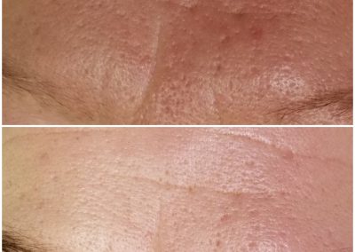Before and after 2 microneedling treatments, 4 weeks apart
