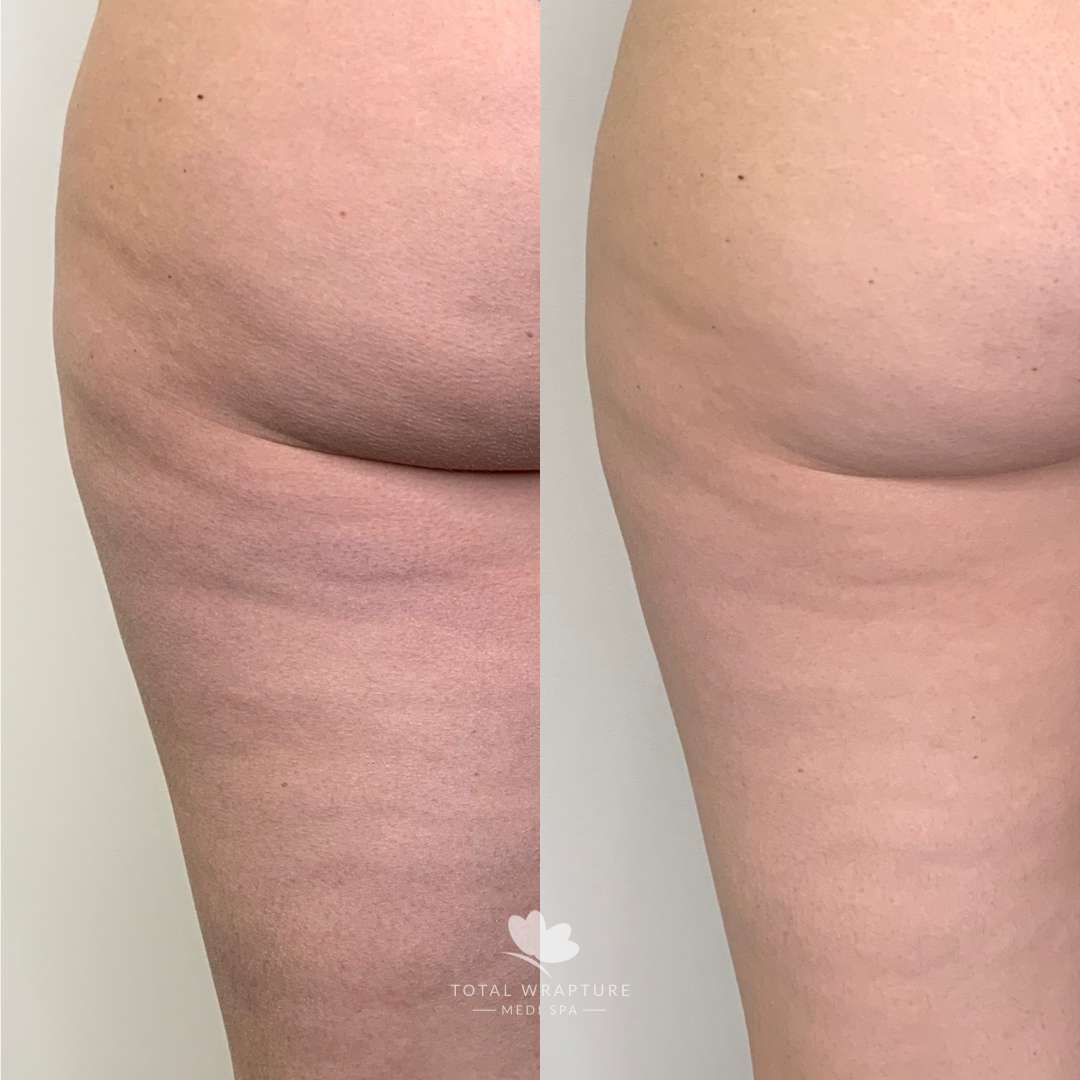 Results of a cellulite treatment on the upper leg.