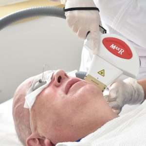 man receiving laser hair removal treatment on cheek