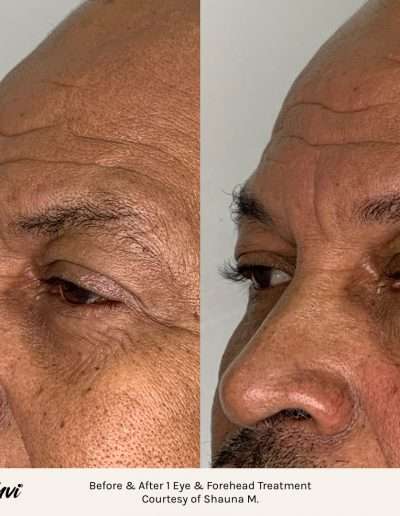 Before and after results of a TempSure Envi treatment on the eyes and forehead