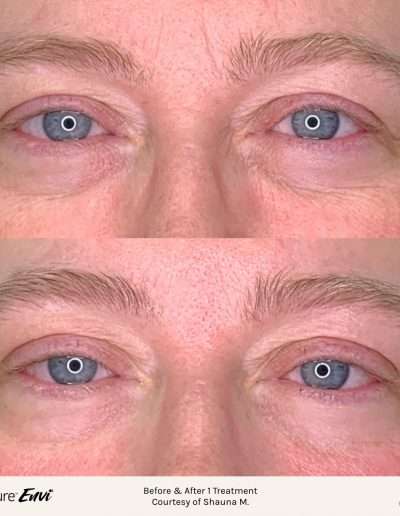 Before and after results of a TempSure Ensvi treatment on the eye