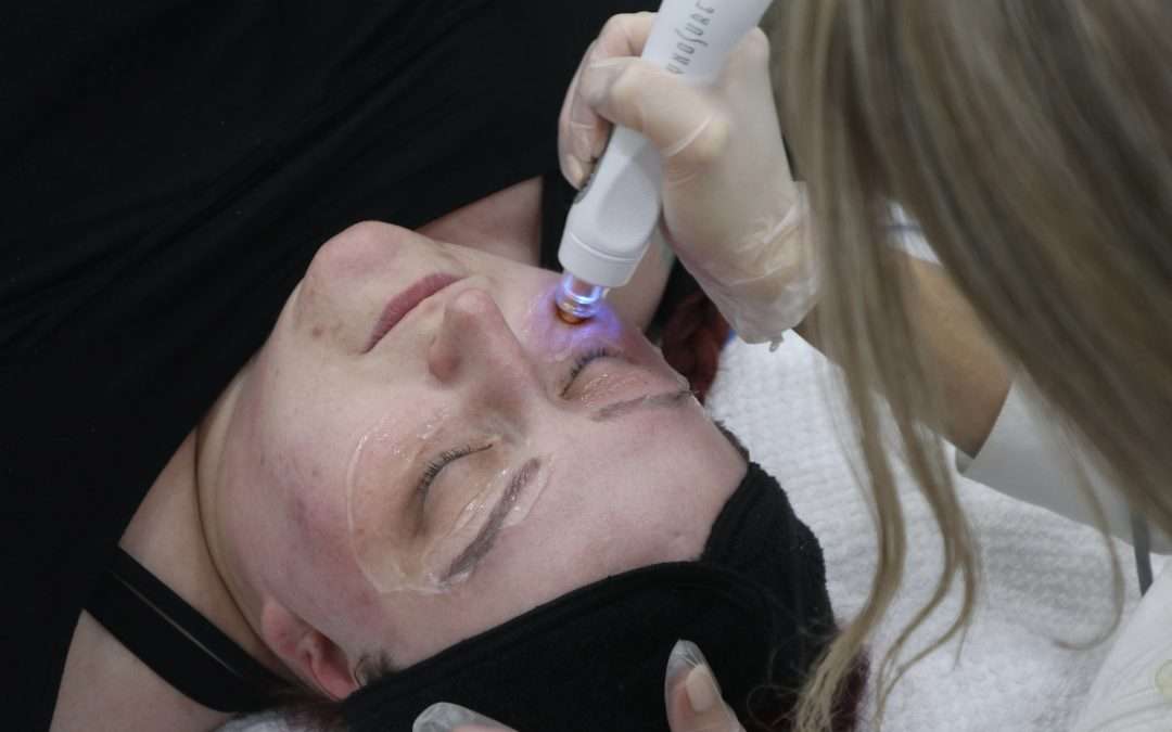 tempsure envi skin tightening on the eye area