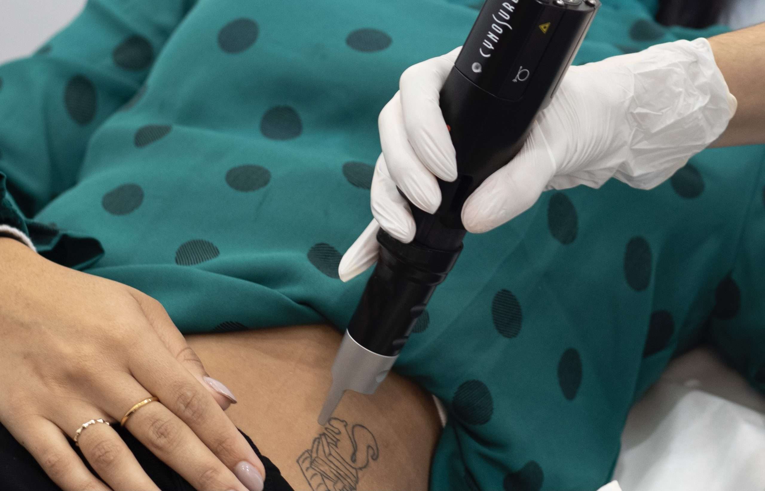 tattoo being removed with picosure machine