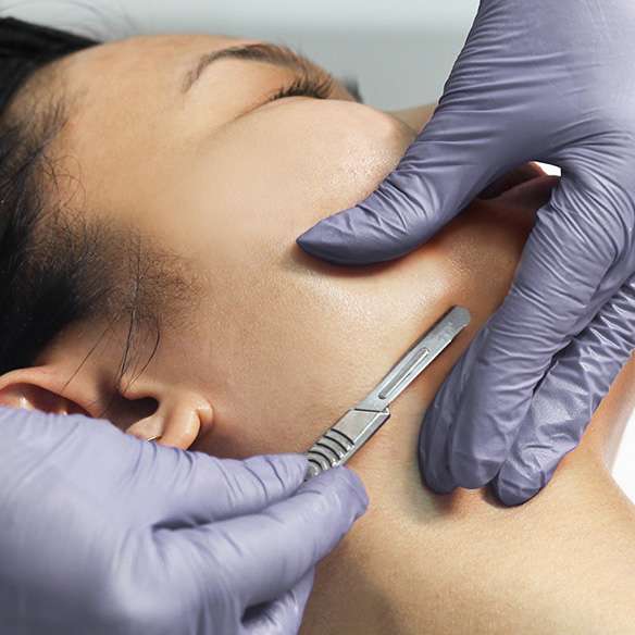 Woman receiving dermaplaning exoliation treatment