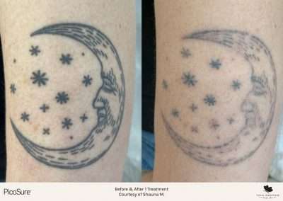 Before and after comparison of tattoo removal after one treatment. Tattoo treated is a crescent moon. First before image displays the crescent moon tattoo in vibrant black ink. Second after image displays the crescent moon tattoo with noticeably faded black ink.