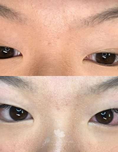 Before and after results of classic lash extensions