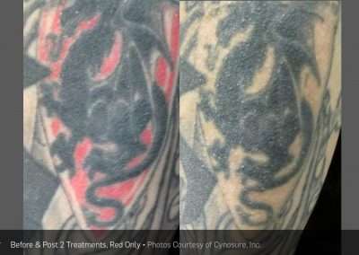 Before and after of tattoo removal with black and red ink. Red ink has been removed.