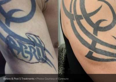 Before and after of partial black ink tattoo removal.