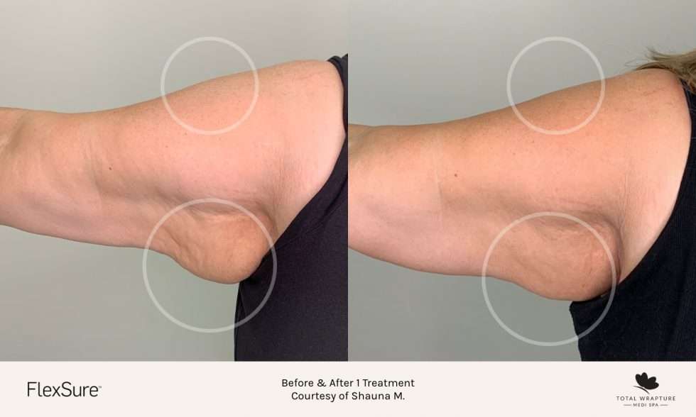 How Does FlexSure Radiofrequency Body Contouring Work?