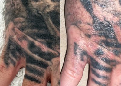 Before and after one tattoo removal treatment. Courtesy of Shauna M at Total Wrapture.