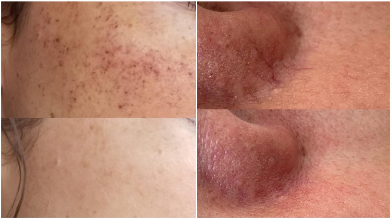 Little Facial Veins: What Causes Broken Capillaries? – Total Wrapture ...