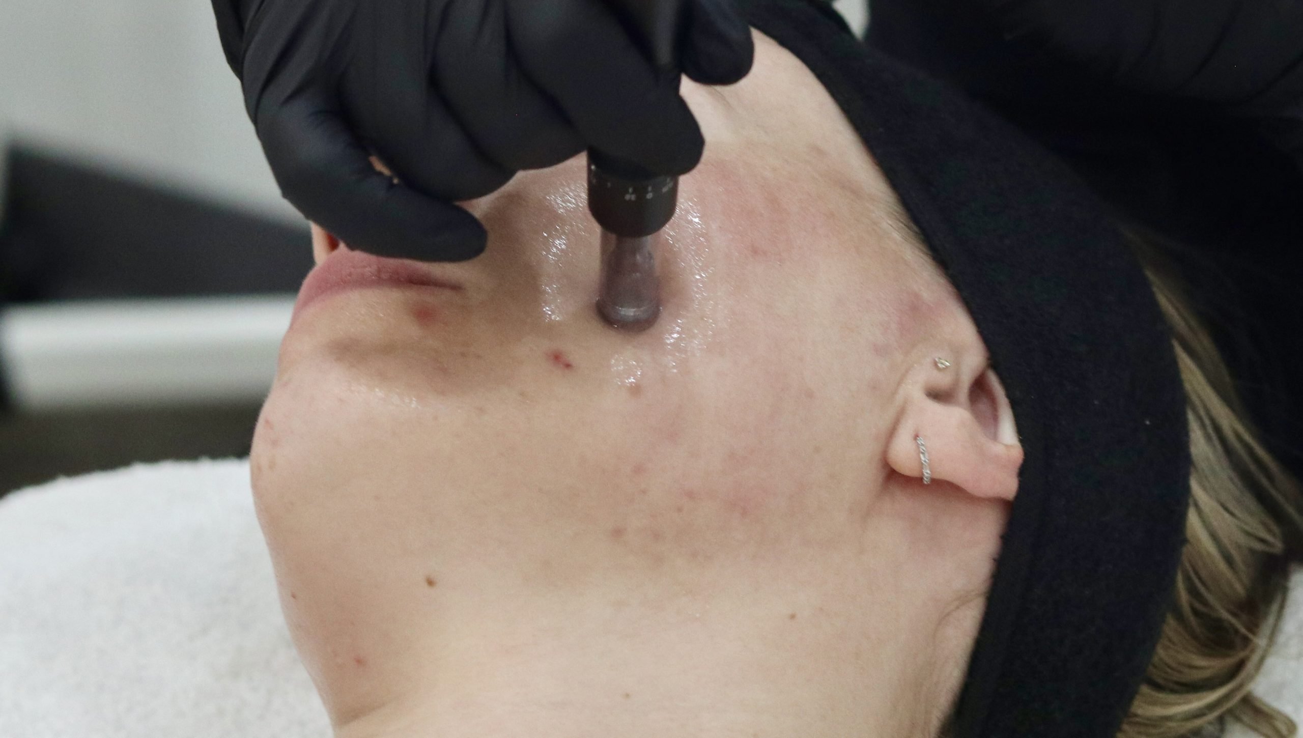 Mesotherapy treatment for acne