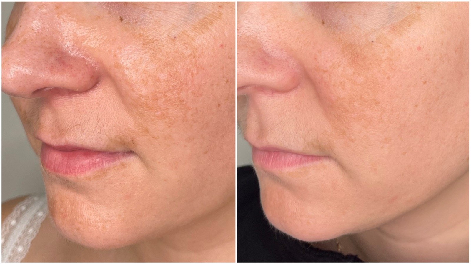 An image demonstrating the effectiveness of PicoSure laser for hyperpigmentation, with dramatic improvement in uneven pigmentation after just one treatment and Vivier product use.