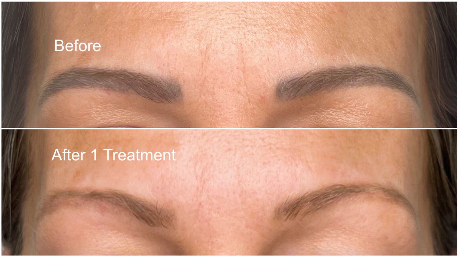 brow micropigmentation or microblading removal in winnipeg Before and after brow micropigmentation removal in winnipeg