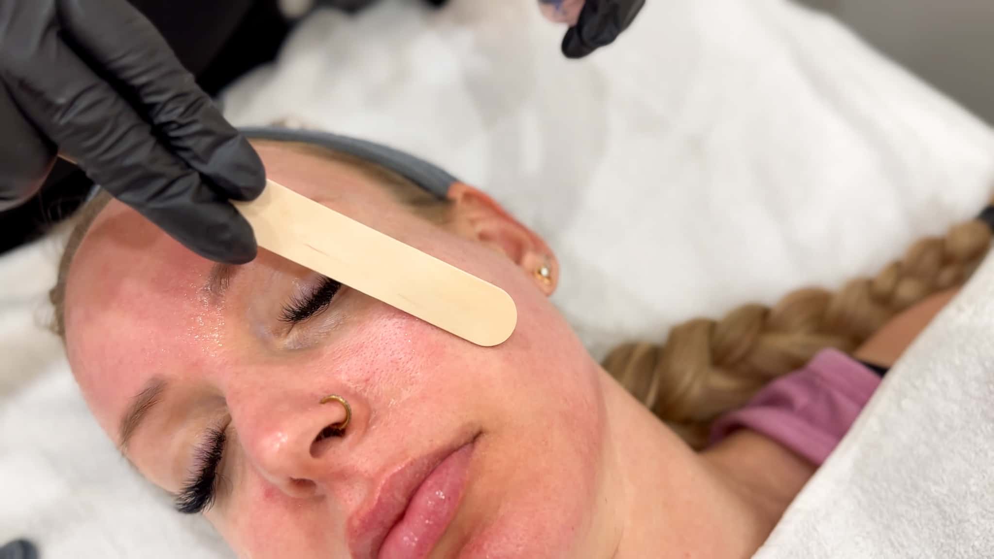 Client receiving an exosome facial in Winnipeg with microneedling at a professional spa treatment room