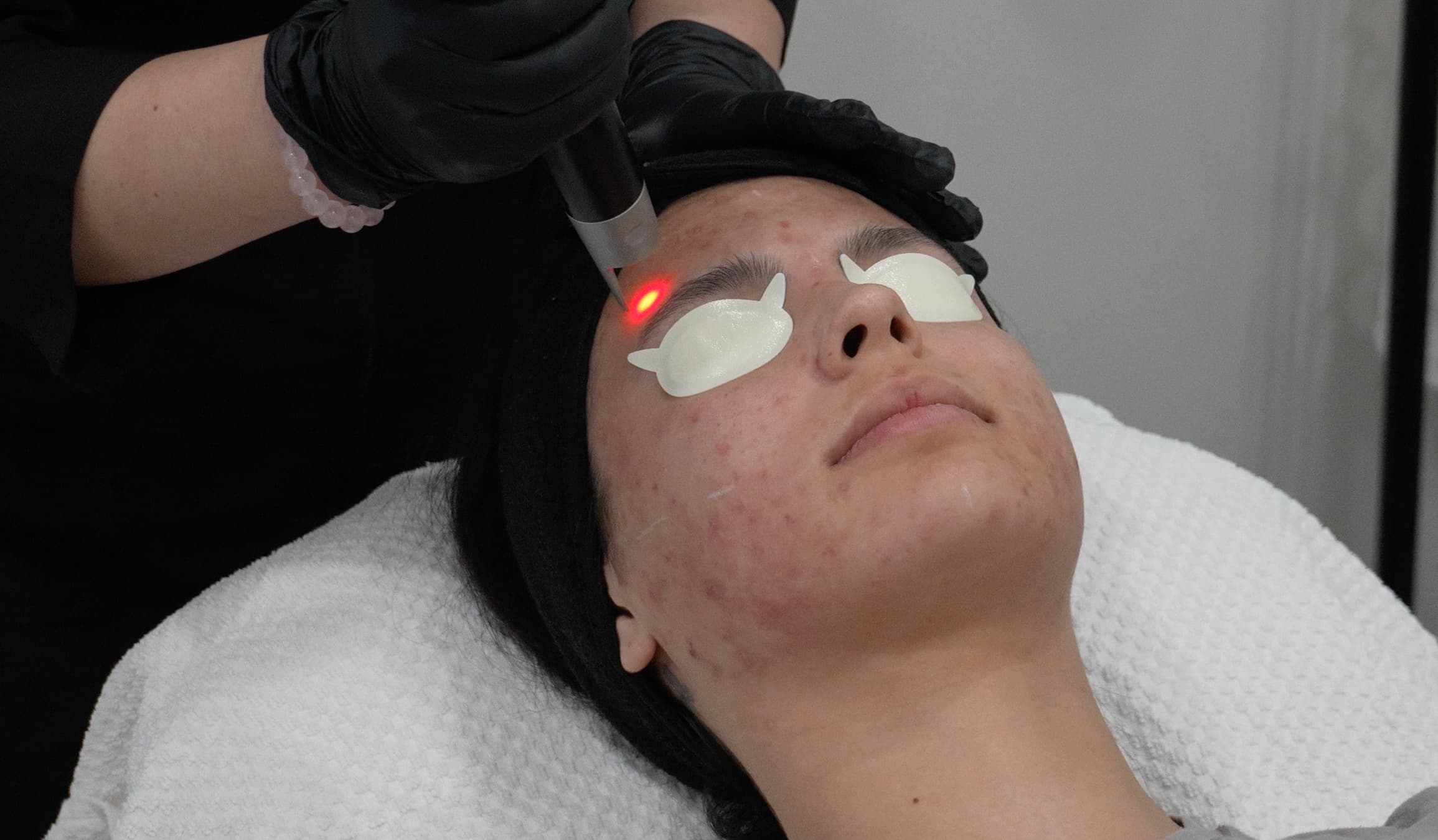 A guest with acne receiving PicoSure laser treatment for acne scars at Total Wrapture Medi Spa in Winnipeg—targeting pigmented marks for clearer, more even-toned skin.