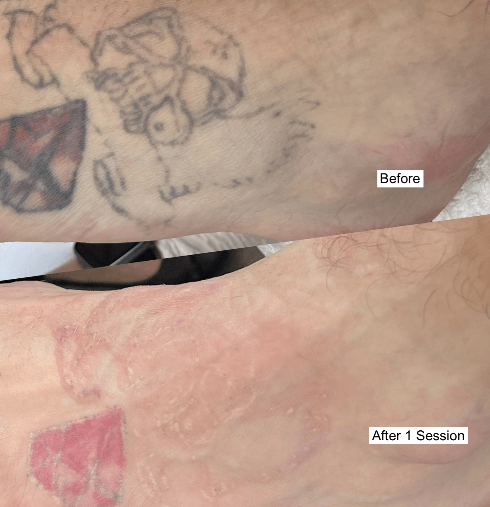 Before and after image showing a visibly faded tattoo following one laser tattoo removal session in Winnipeg—partial ink breakdown is clearly noticeable.