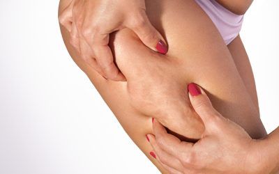 How to Get Rid of Cellulite: Your Complete Guide