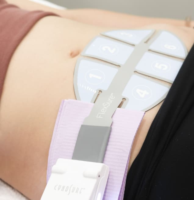 Close-up of a FlexSure RF body contouring treatment in progress, showing the applicator secured to a client’s abdomen using a lavender strap.