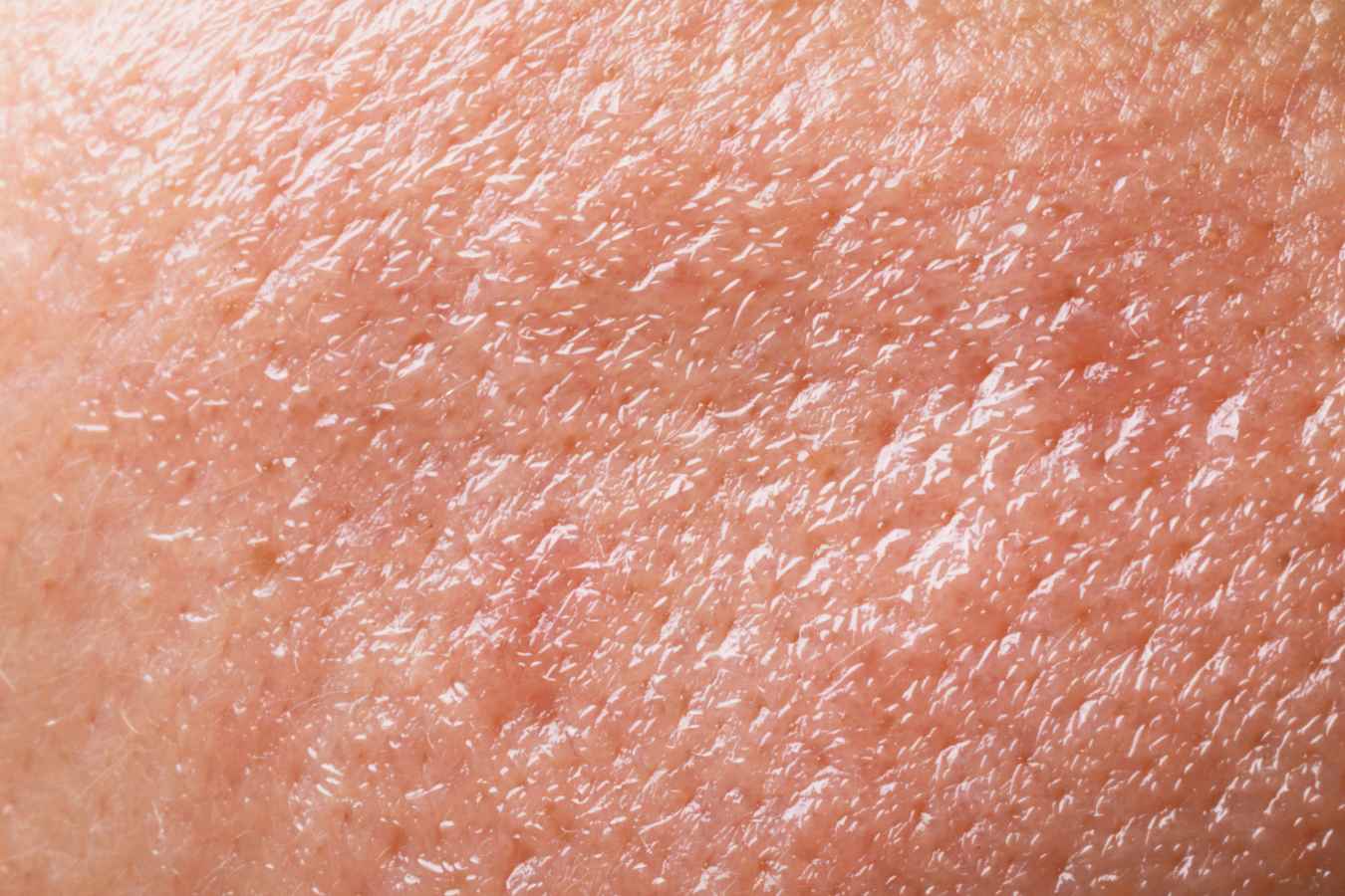 Ultra-shiny skin surface reflecting excess oil production, included for the skincare question How Do I Stop My Skin From Being So Oily?