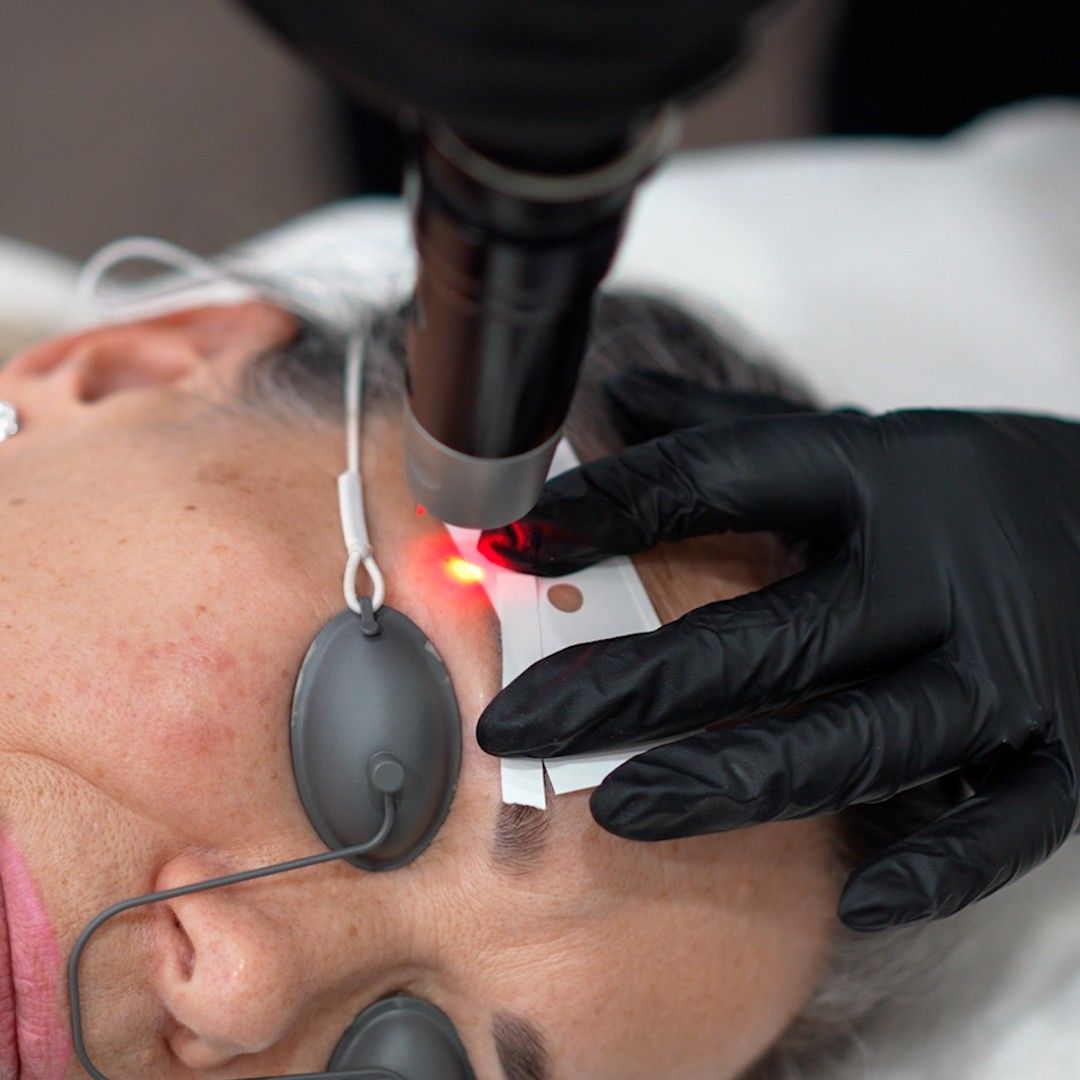 Eyebrow Tattoo Removal