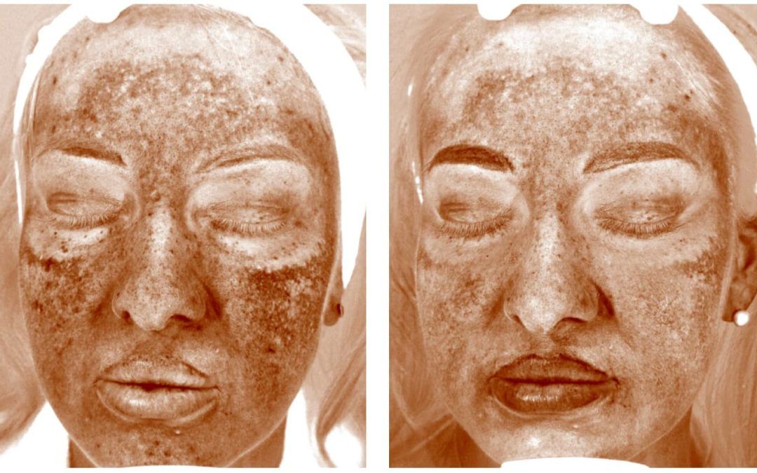 UV imaging showing reduction in sun damage and pigmentation after 12 weeks of using Vivier Serum 30 Vitamin C daily vitamin c