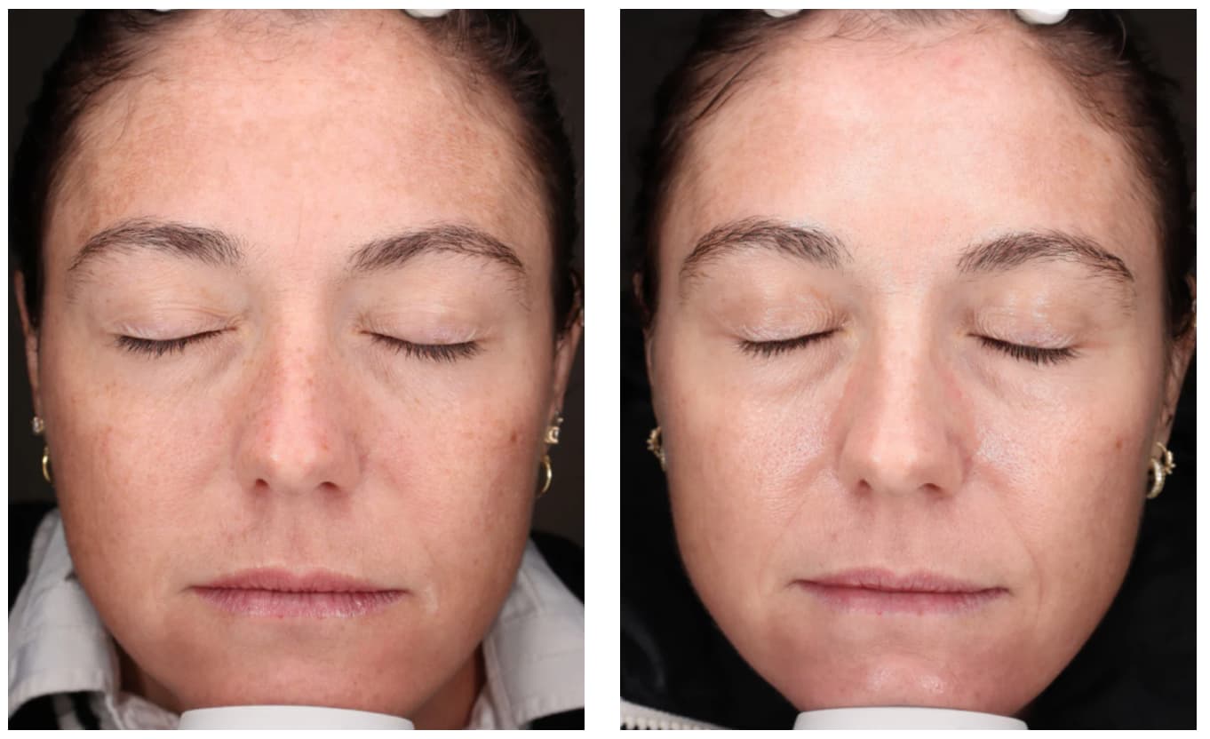Before and after results showing brighter, more even skin tone after 12 weeks of using Vivier Serum 30 daily Vitamin C