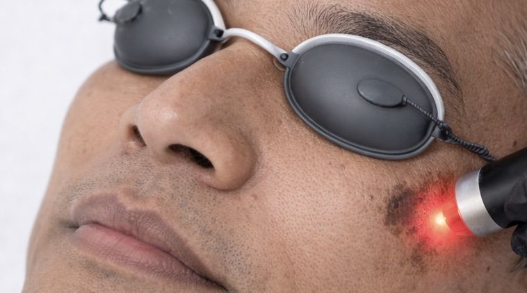 man getting a laser pigmentation facial at a winnipeg skin clinic