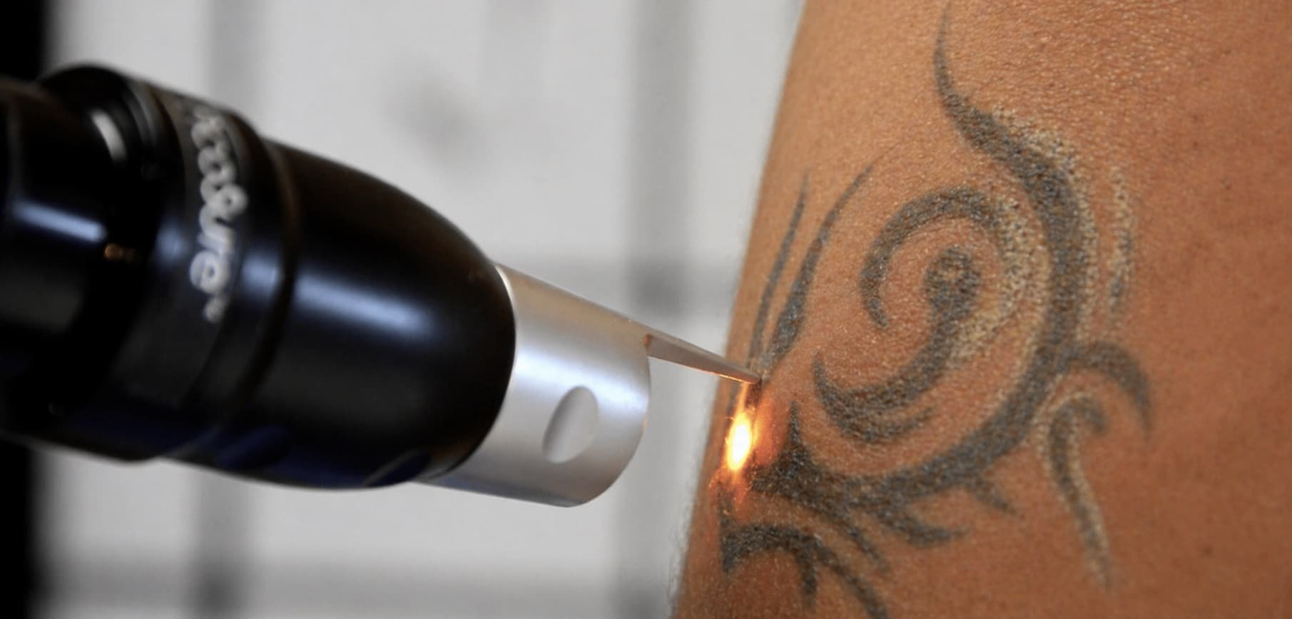 Close-up of a laser tattoo removal treatment in progress, showing a handheld laser device emitting a small, bright pulse of light onto a simple swirl-style tattoo design. The ink appears to be breaking down as the laser targets the pigment, with the surrounding skin slightly raised and textured. The background is softly blurred, keeping the focus on the precision of the device and the tattoo removal process.