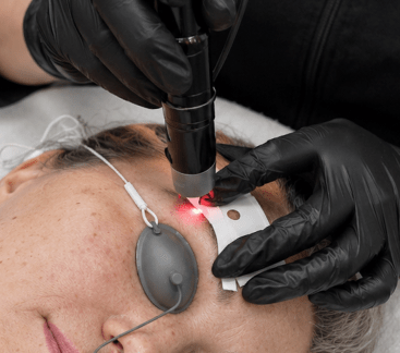 Microblading removal