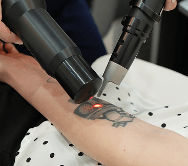 Tatto removal treatment