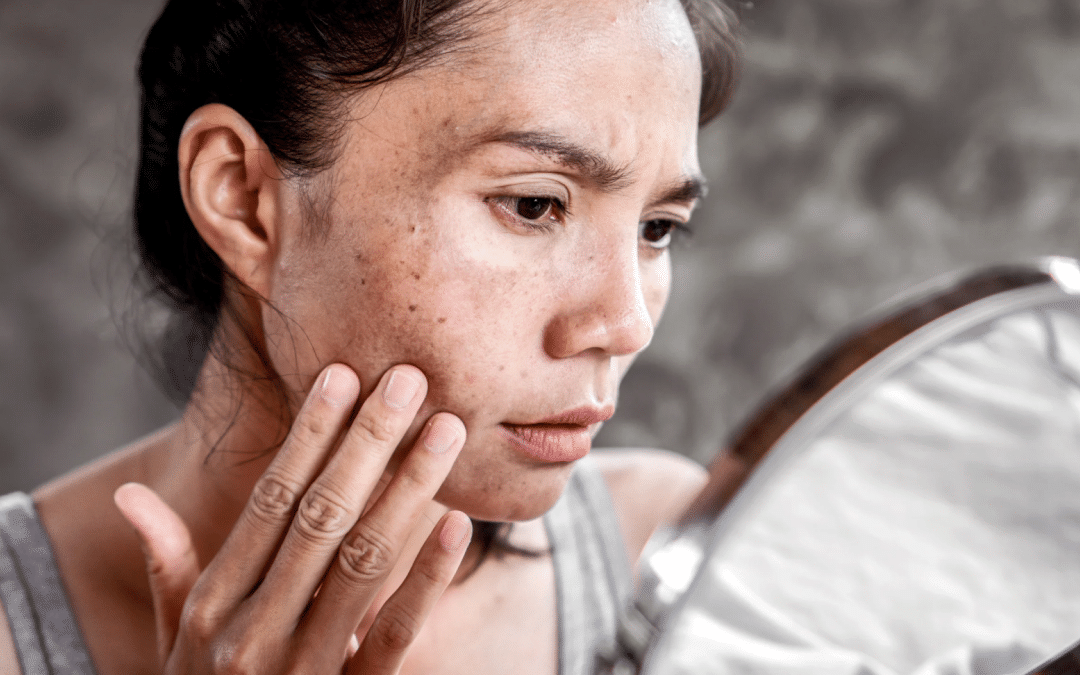 Dull skin